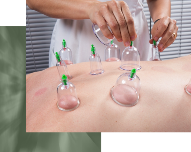 Massage therapist performing cupping technique on person's back
